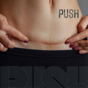 s-section scar