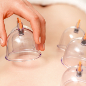 Read more about the article Cupping Therapy